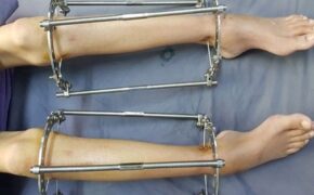 Nắn chỉnh, kéo dài chân làm đẹp coi chừng tai biến