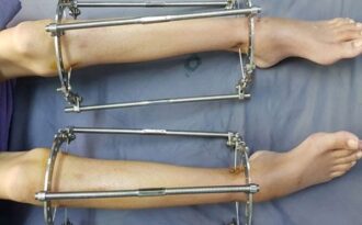 Nắn chỉnh, kéo dài chân làm đẹp coi chừng tai biến