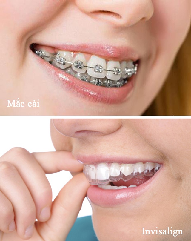 Công nghệ niềng răng Invisalign (ảnh dưới) sẽ không gây mất tự tin.