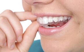 Công nghệ niềng răng Invisalign không gây mất tự tin