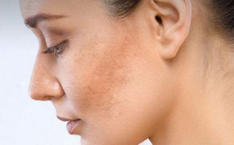 Chia tay nám “khó hóa dễ” nếu bạn biết đến Glutathione BC White