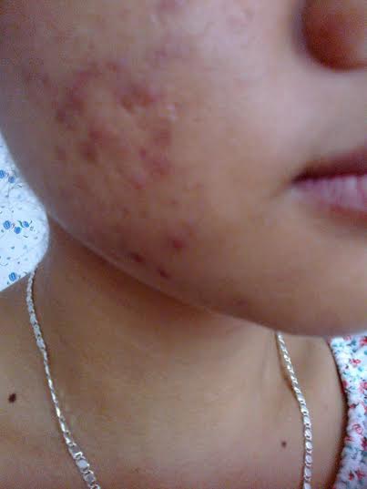 Chia tay mụn, sẹo mụn, sẹo thâm: Khó mà dễ - 1 Chia tay mụn, sẹo mụn, sẹo thâm : Khó mà dễ