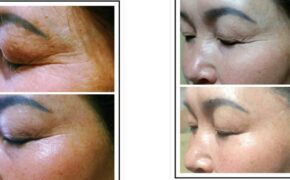 Transfer Double Nanosphere – Công nghệ siêu trẻ hóa da Hàn Quốc