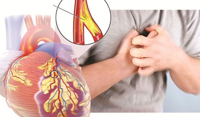 Coi thường mỡ nhiễm máu - Những biến chứng nguy hiểm không ngờ - 1 Coi thường mỡ nhiễm máu - Những biến chứng nguy hiểm không ngờ - 1