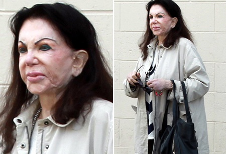 Nữ diễn viên 92 tuổi mặt méo xệch vì phẫu thuật thẩm mỹ