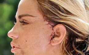 “Hoảng sợ” với gương mặt sau phẫu thuật thẩm mỹ của Katie Price