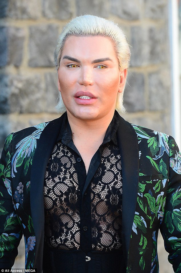  Rodrigo Alves đã cắt bỏ xương sườn rồi đeo eo định hình để có vòng hai nhỏ hết mức. 