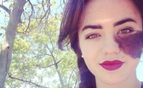 Vẻ đẹp rạng ngời của nữ vũ công trẻ bị chàm nửa mặt