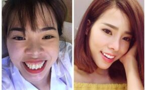 Cô gái chi 200 triệu “đập đi làm lại” khuôn mặt và giấc mơ 10 năm thành hiện thực