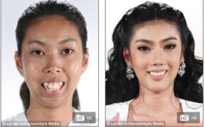 Cô gái “từ vịt hóa thiên nga” nhờ phẫu thuật thành công