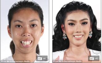 Cô gái “từ vịt hóa thiên nga” nhờ phẫu thuật thành công