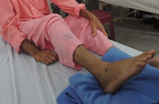 Nhiều sai lầm khi xử lý rắn cắn