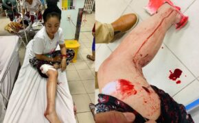 Danh hài Thúy Nga gặp tai nạn phải khâu gần 10 mũi