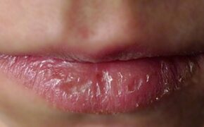 Làm gì khi môi bị khô nẻ trong mùa hanh khô