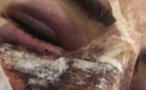 Người đẹp Anh chia sẻ ảnh sốc sau thẩm mỹ