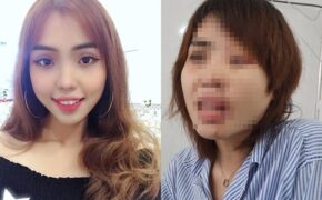 Nỗi đau ám ảnh của cô gái xinh đẹp bị chồng chưa cưới tạt axit