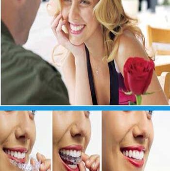 Chỉnh nha Invisalign không cần mắc cài