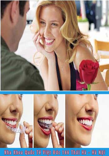 Chỉnh nha Invisalign không cần mắc cài