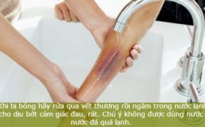 Mẹo chữa bỏng nhẹ nhờ nguyên liệu tự nhiên