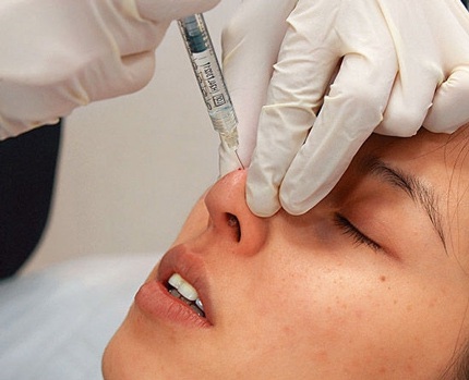 Trần Tư Tề khoe những bức ảnh ghi lại cảnh cô tiêm botox vào mũi