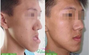 Phẫu thuật ca móm khó 5 năm không khép được miệng