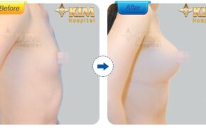 Nâng ngực nội soi 3D: Những hệ lụy bạn cần biết