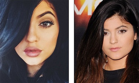 Kylie Jenner bị chỉ trích vì làm phẫu thuật khi còn ít tuổi