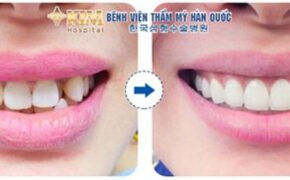 Bọc răng sứ với mặt dán sứ Veneer không đau tại bệnh viện thẩm mỹ KIM