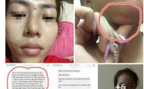 Mũi lệch, môi sưng, cằm vón cục vì bơm chất làm đầy