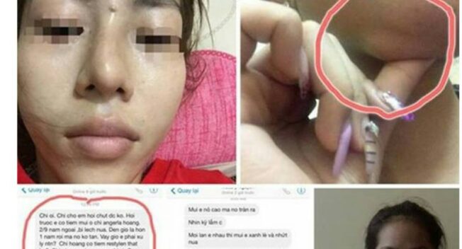 Mũi lệch, môi sưng, cằm vón cục vì bơm chất làm đầy