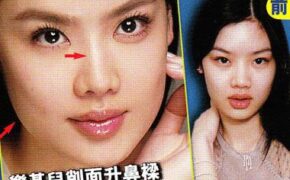 Vợ Lê Minh bị nghi phẫu thuật mũi