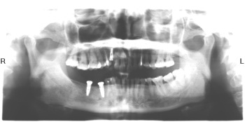 Quy trình cấy ghép implant - 2