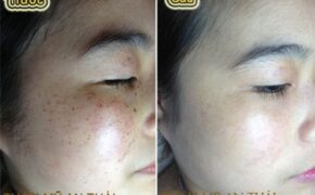 Kinh nghiệm điều trị tàn nhang tận gốc