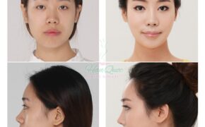 Thẩm mỹ khuôn mặt đẹp toàn diện tại Thẩm mỹ JW