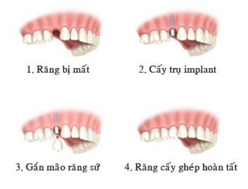 Implant nha khoa phần 2: Lợi ích của Implant - 2