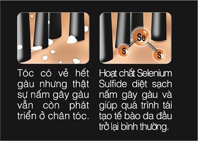 Làm sao để trị gàu tận gốc, không bị tái đi tái lại tình trạng gàu và bết ngứa ?