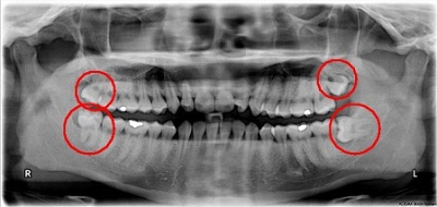 Những tác hại khôn lường do răng khôn mọc lệch