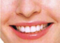 Răng sậm màu và phương pháp cải thiện