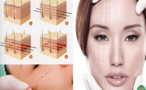 Nâng cơ mặt hiệu quả bằng chỉ Hàn Quốc