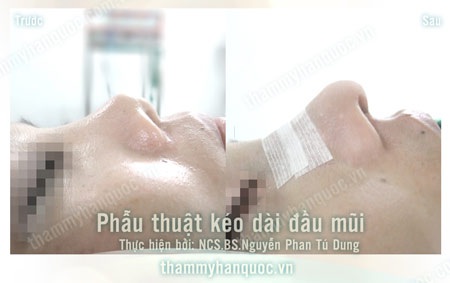 Bệnh nhân này đã phẫu thuật sửa mũi nhiều lần, mũi bị co rút ngắn hoàn toàn. Bệnh nhân