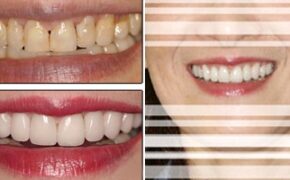 Bọc răng sứ – cách tốt nhất cho răng sậm mầu