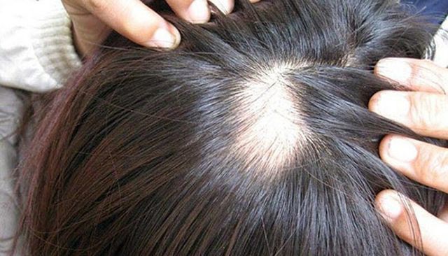 Xóa tan nỗi lo các bệnh về tóc qua các loại dược liệu thảo dược - 2