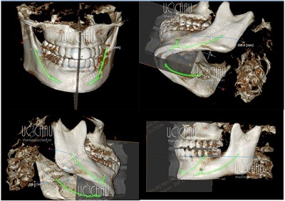 Phần mềm 3D giúp thấy được dây thần kinh (màu xanh) và cấu trúc rõ ràng của xương vùng mặt.