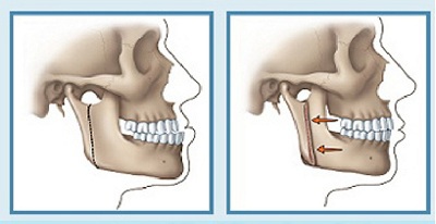 Quy trình cắt xương hàm chỉnh hô thực hiện như thế nào?