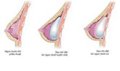 Ngực đẹp là điều mơ ước của nhiều phụ nữ