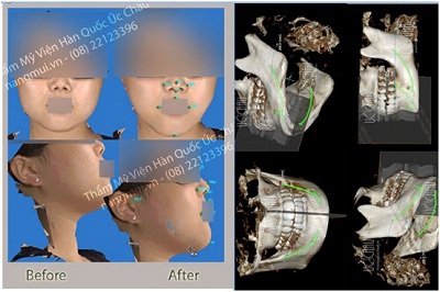 Phẫu thuật khuôn mặt được chụp hình và mô phỏng từ bên ngoài và cấu trúc xương bên trong