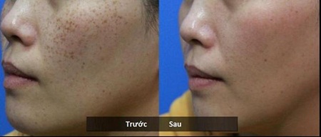 Sự khác biệt rõ ràng ngay sau lần điều trị đầu tiên