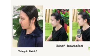 Bạch Mộc Nhiên – Giải pháp hỗ trợ điều trị nám, tàn nhang an toàn hiệu quả