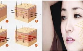 Căng da mặt bằng chỉ với bác sỹ Hàn Quốc