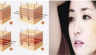 Căng da mặt bằng chỉ với bác sỹ Hàn Quốc